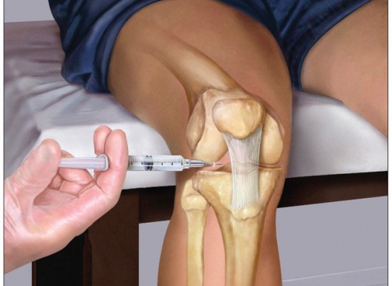 infiltração articular joelho 