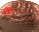 acidente vascular encefálico provocado por enfermidades reumáticas