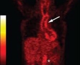 arterite de takayasu