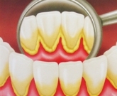 Artrite reumatoide e boca 