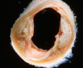 artrites e aterosclerose 