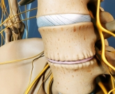 Discopatia degenerativa 