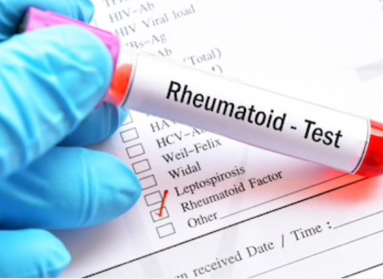 fator reumatóide