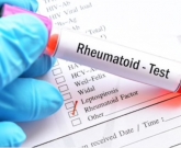 fator reumatóide
