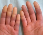 Fenômeno de Raynaud: atenção para reumatismo 