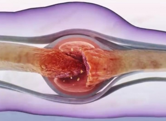 imunobiológicos e artrite psoriásica