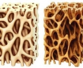 medicamento osteoporose 