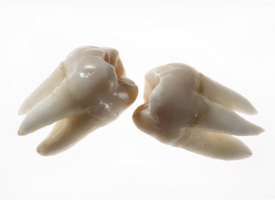 perda dentária e enfermidade reumática