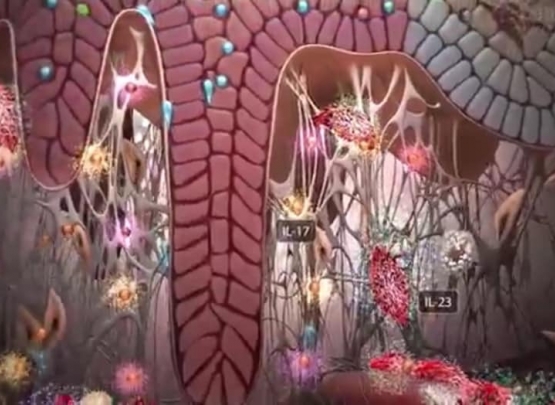 psoríase tratamento