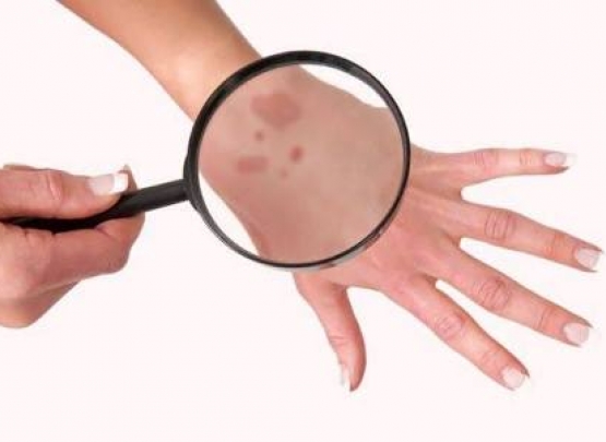 Purpura o que pode ser 