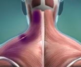 Síndrome miofascial 