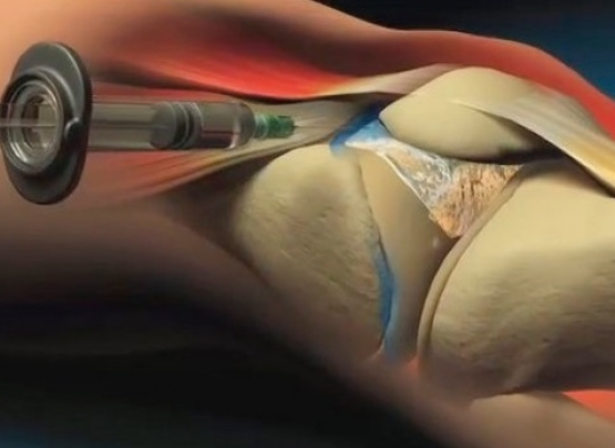 viscossuplementação